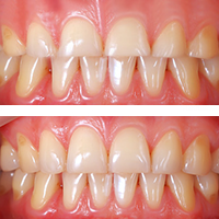 A before and after of an image that shows an uneven smile.