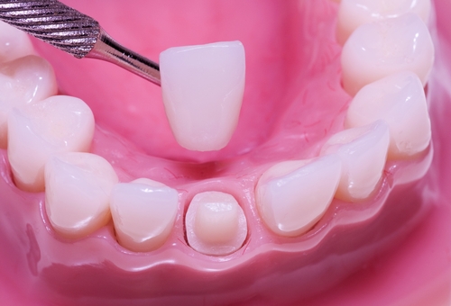 Image of a dental crown being placed on a prepared tooth.