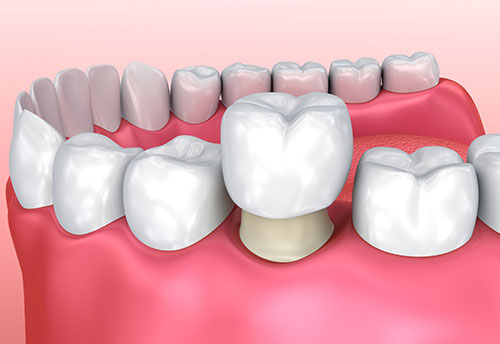 Illustration of Dental Crown being placed on a prepared tooth.