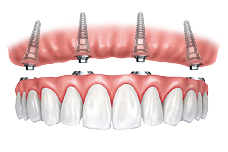 Illustration of an implant supported dental arch.