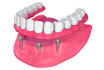 Illustration of implant-supported Dentures.