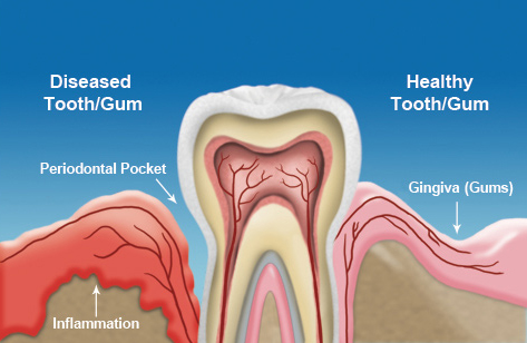 Gum Disease diagram