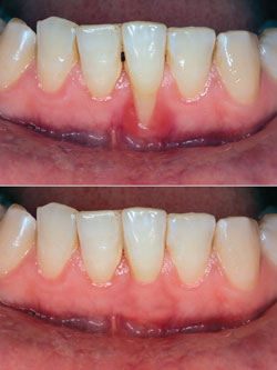 Before and after image of receding gums that have been repaired.