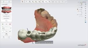 Image of CAD/CAM Treatment Planning software.