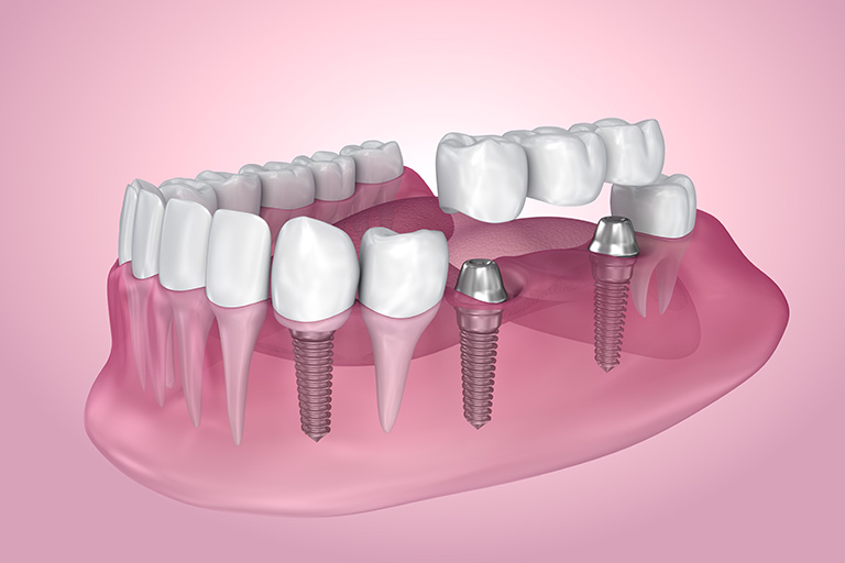 Illustration of a dental implant bridge.