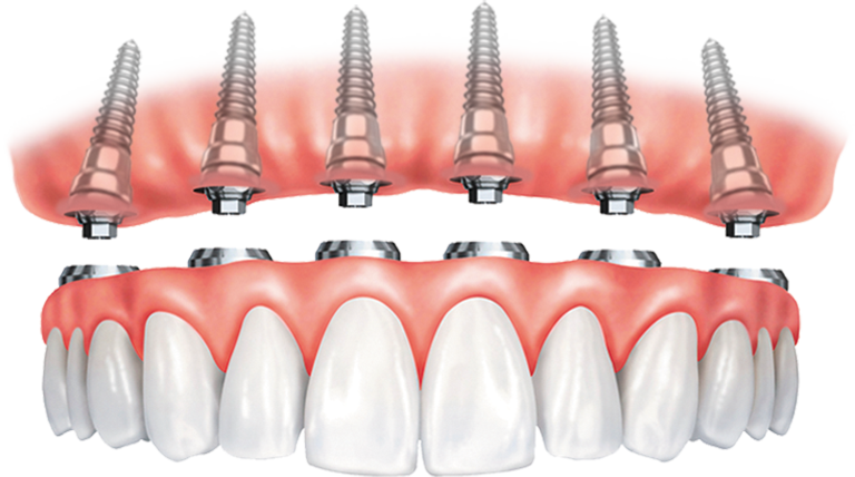 Illustration of an implant-supported upper arch of teeth.