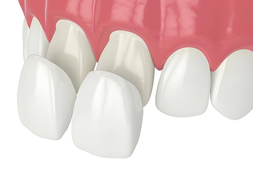 Illustration of Porcelain Veneers being placed on prepared teeth.